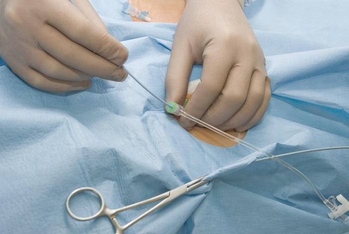 Urine Catheter Insertion At Home In Gurugram